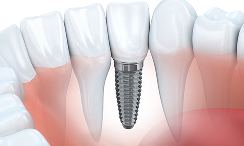 Dental Implants in St. John